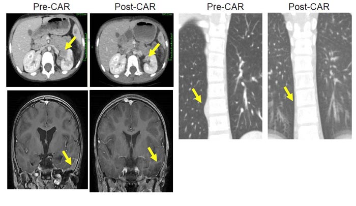 CAR-T